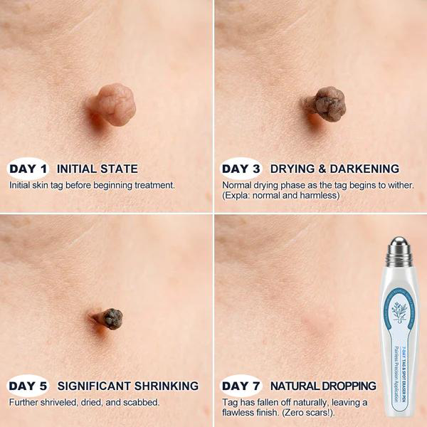 𝐉𝐎𝑼𝐒®💎 Official Store7-𝐷𝑎𝑦 𝗧𝐚𝐠 & 𝗦𝗽𝐨𝐭 𝐄𝐫𝒂𝒔𝒆𝒓(Zero Pain, Zero 𝐒𝐜𝐚𝒓𝒔 Rollerball)