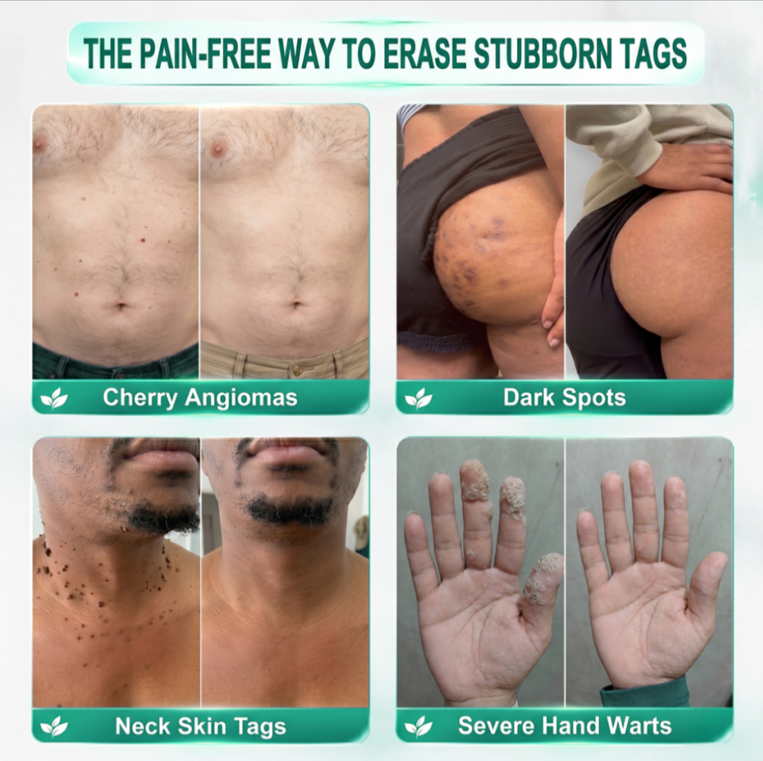 Mrevbsin® Botanical Microneedle Hydrocolloid Patch