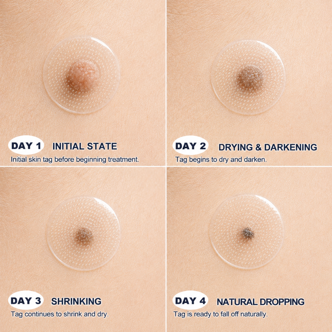 Mrevbsin® Botanical Microneedle Hydrocolloid Patch