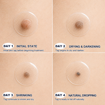 Mrevbsin® Botanical Microneedle Hydrocolloid Patch